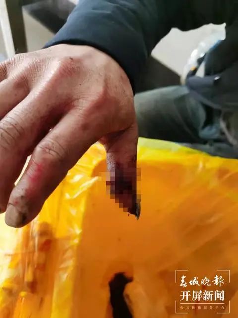黑人！昭通一村民进山挖笋被黑熊袭击，全身多处受伤！紧急转至宜宾治疗！-1.jpg