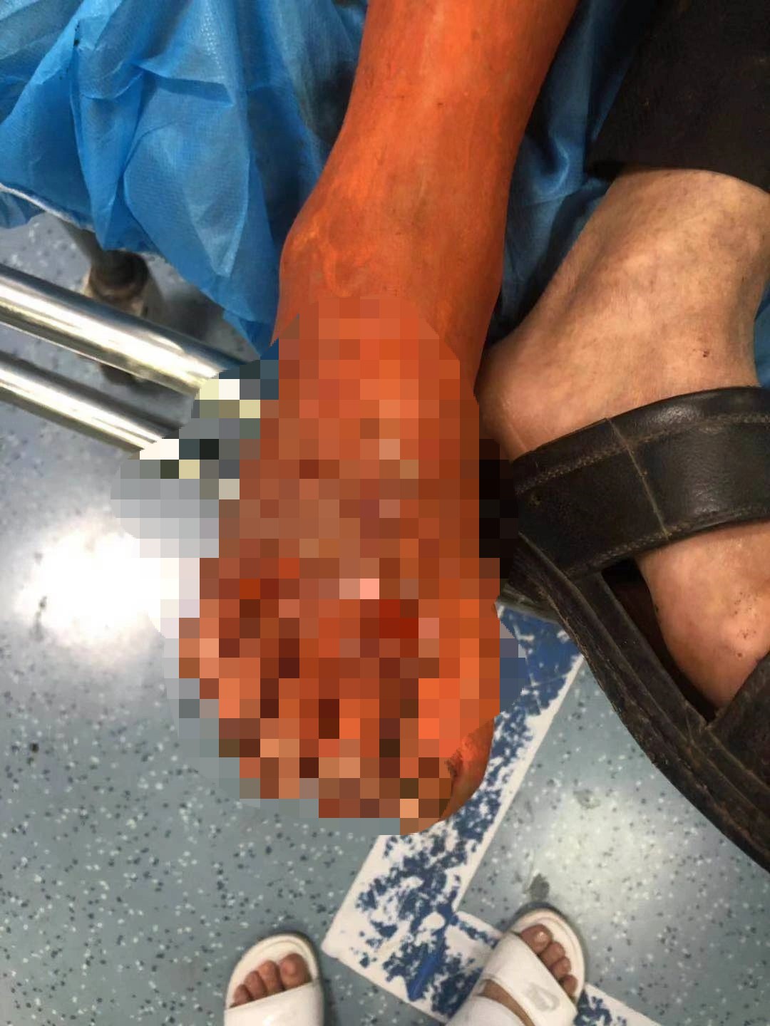 宜宾一老人被毒蛇咬伤，腿差点就保不住了…-1.jpg