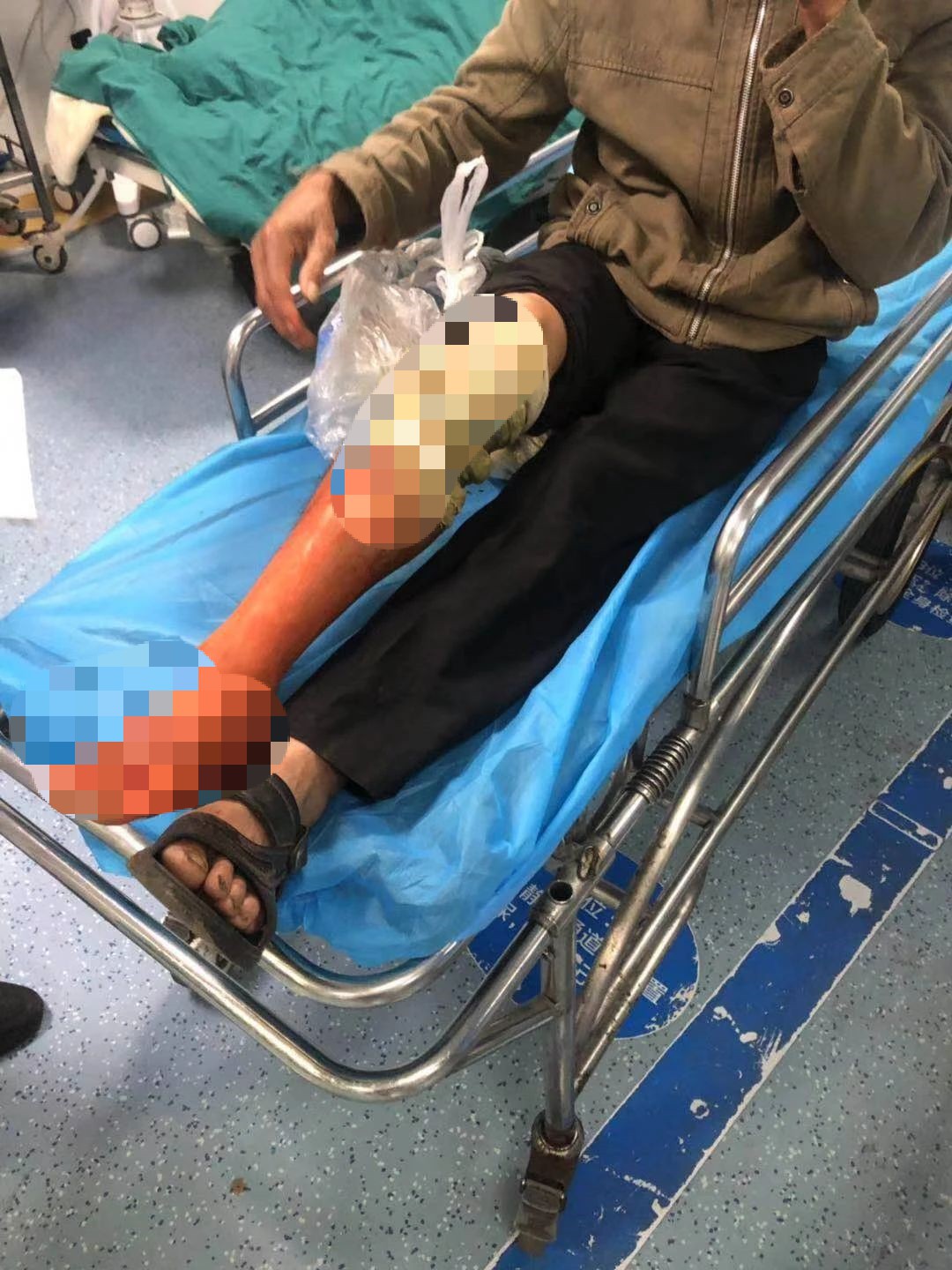 宜宾一老人被毒蛇咬伤，腿差点就保不住了…-2.jpg