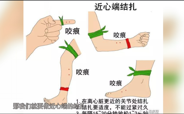 蛇出没！宜宾一名男子被毒蛇咬伤，整条腿都肿了！-6.png
