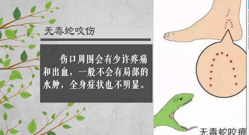 蛇出没！宜宾一名男子被毒蛇咬伤，整条腿都肿了！-2.png