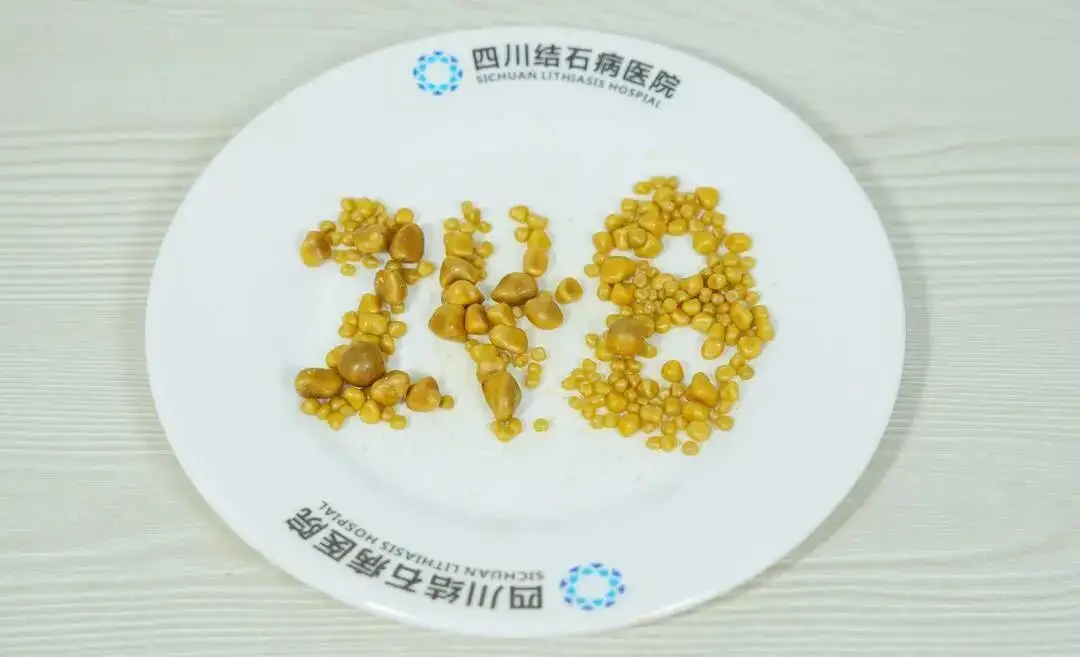 26岁男子三餐吃外卖，胆囊内长出248颗结石
New